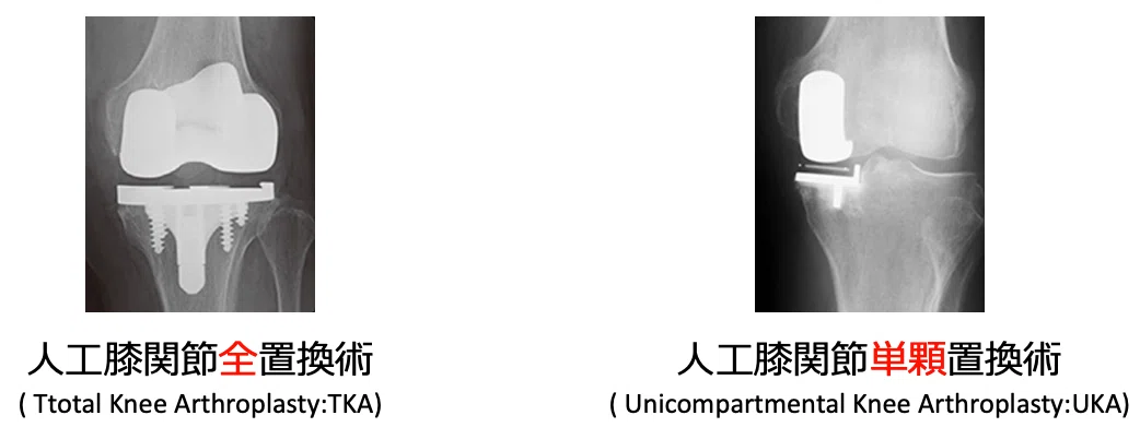 初学者必見】人工膝関節置換術を「攻略」するロードマップ ー最新