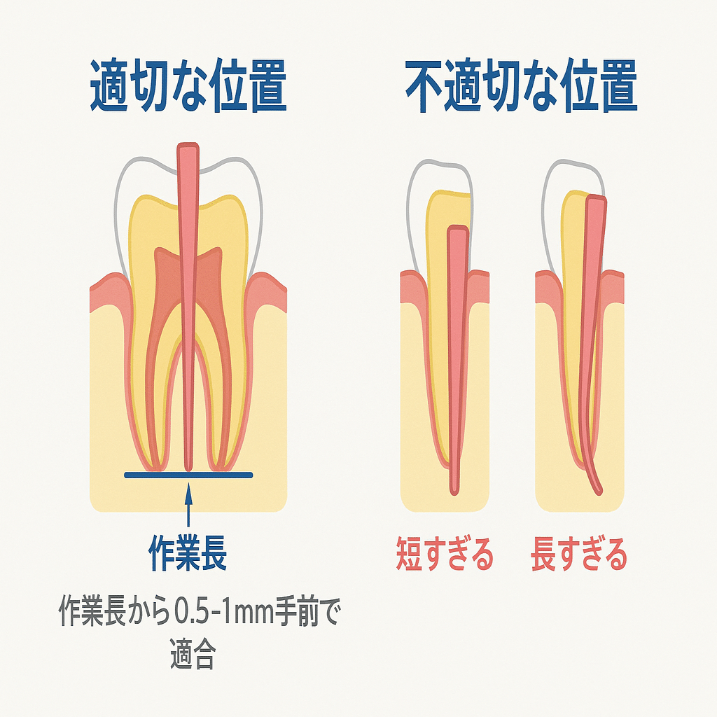 根管治療の成功へ導く：適切な拡大位置の見極め方と5つの実践ステップ