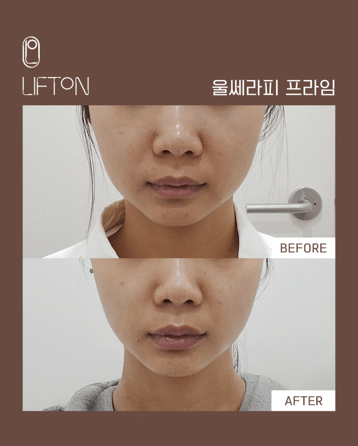 ウルセラ・オンダリフト。簡単ガイドブック！「韓国皮膚科リプトン