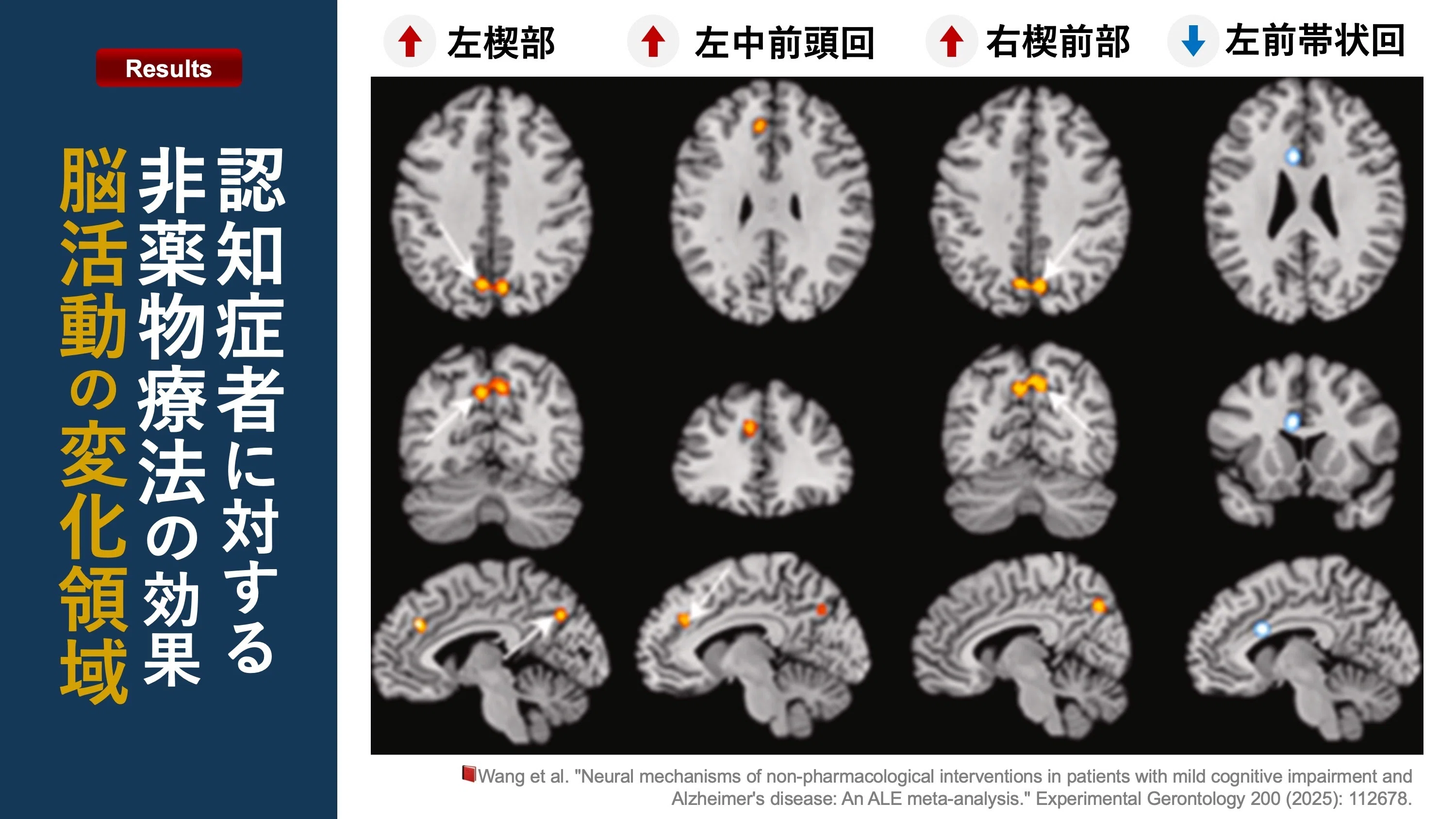 認知症者に対する非薬物療法の効果。脳活動の変化領域｜Super Human