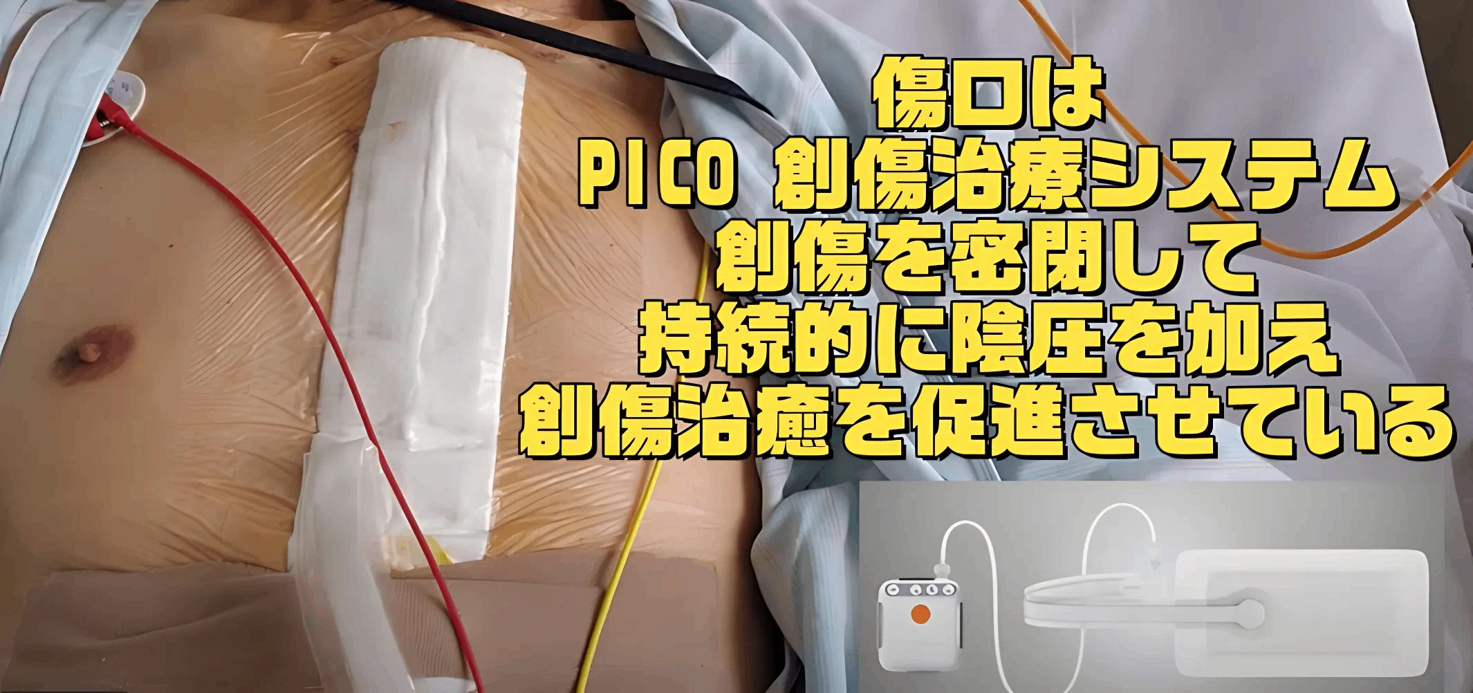 ★I saw my chest after the median sternotomy!｜★AR HappySmile★