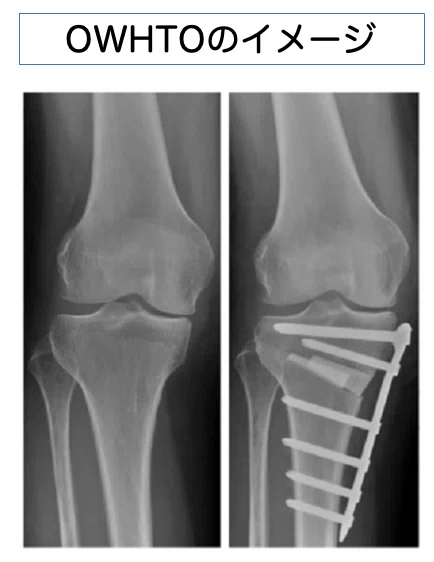 Knee/Surgery] Osteotomy for the Knee Joint: What Can Be Done