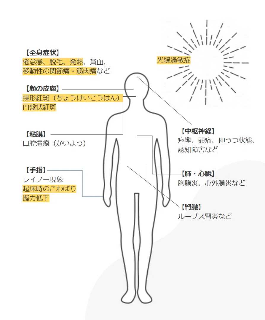 全身 性 エリテマトーデス 症状