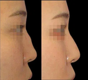 【執刀医解説】ハンプ減量 凹みの治療（鼻背軟骨移植）｜M.D., Ph.D.横山才也