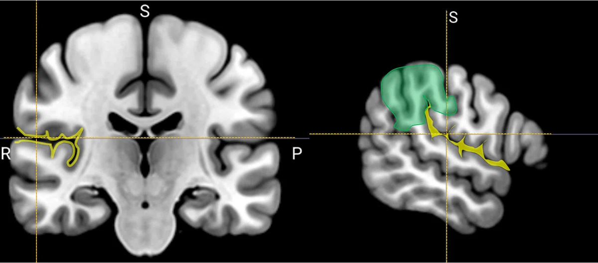 リハビリテーションと脳画像⑧ーMRI・CTによる縁上回と角回の同定ー|J. Rehabilitation