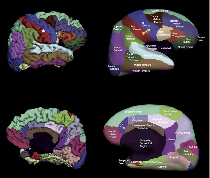 リハビリテーションと脳画像⑧ーMRI・CTによる縁上回と角回の同定ー|J. Rehabilitation