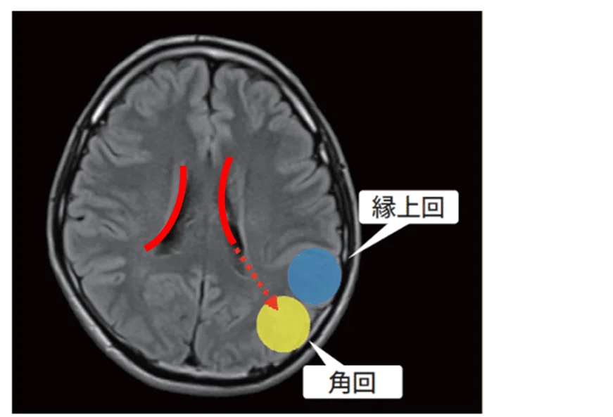 リハビリテーションと脳画像⑧ーMRI・CTによる縁上回と角回の同定ー|J. Rehabilitation