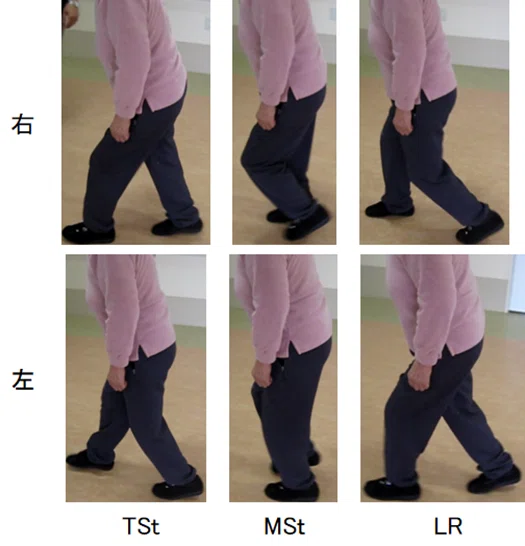 前のめりの歩行により転倒の危険性がある症例|理学療法士 おかむー