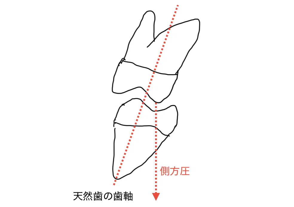 咬合理論（リンガライズドオクルージョン）について！｜Hiro
