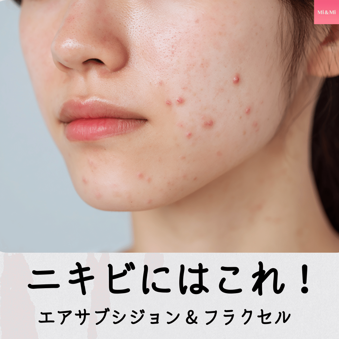 ✨ニキビ・ニキビ跡でお悩みの方へ✨エアサブシジョン × フラクセルでW