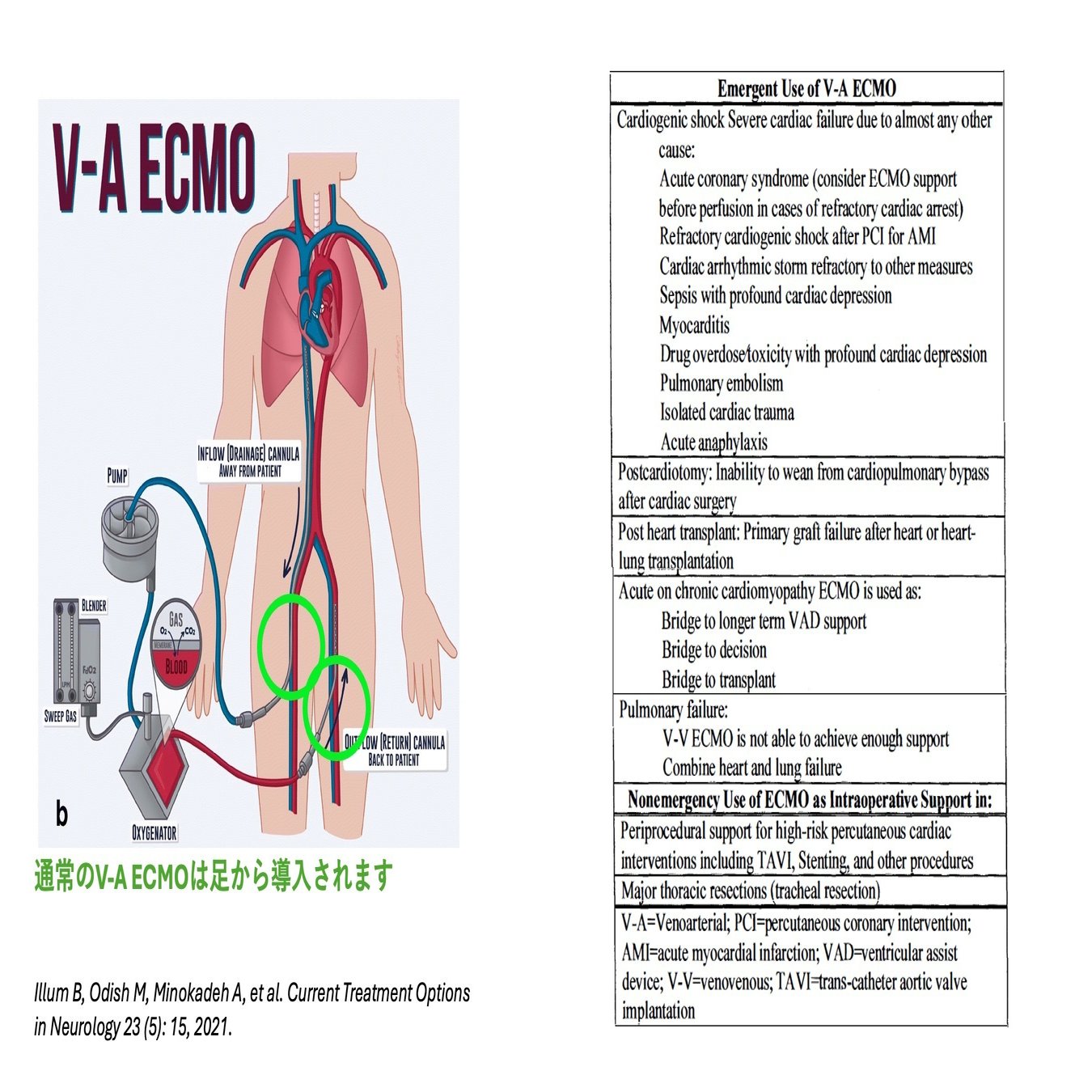 RV XP 心臓血管外科プロフェッショナル EL MU ファロー四徴症モデル：TOF（XC-04CDc）
