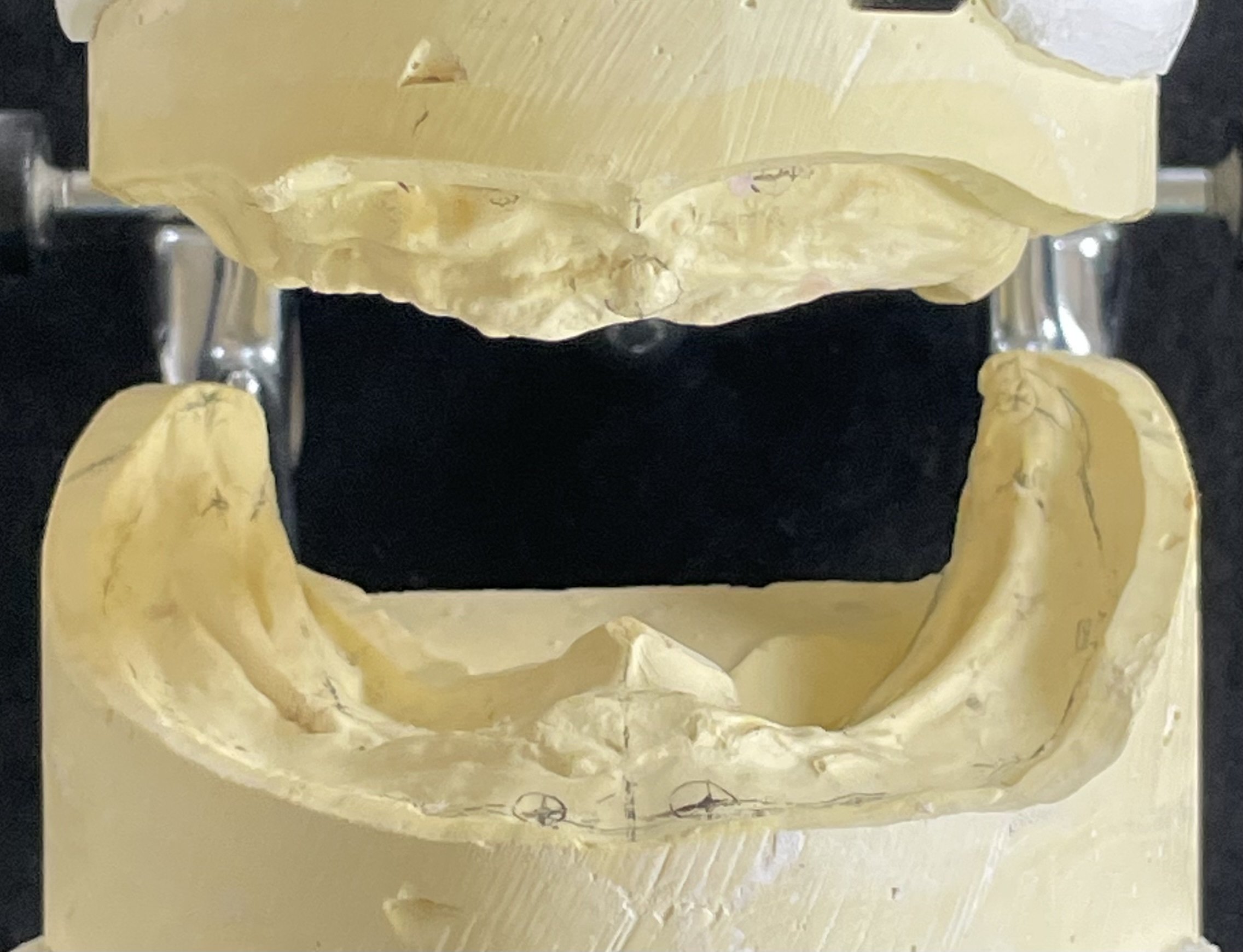 顎骨（歯槽骨）吸収と総義歯の歯槽頂間線の法則について。｜Hiro