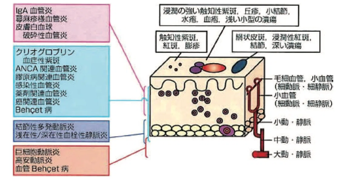 【病理】皮膚血管炎|ペパロニ備忘録