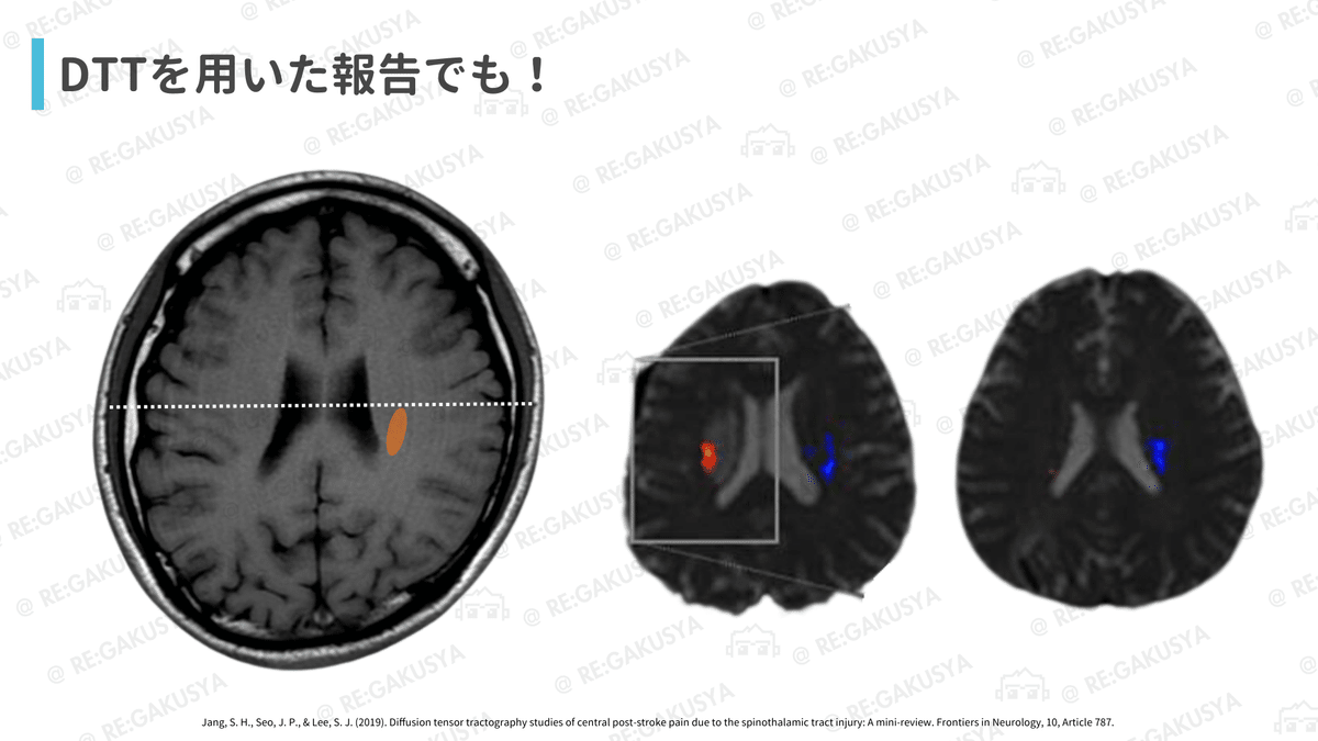 サギョウ先生の臨床推論（放線冠）｜サギョウ先生