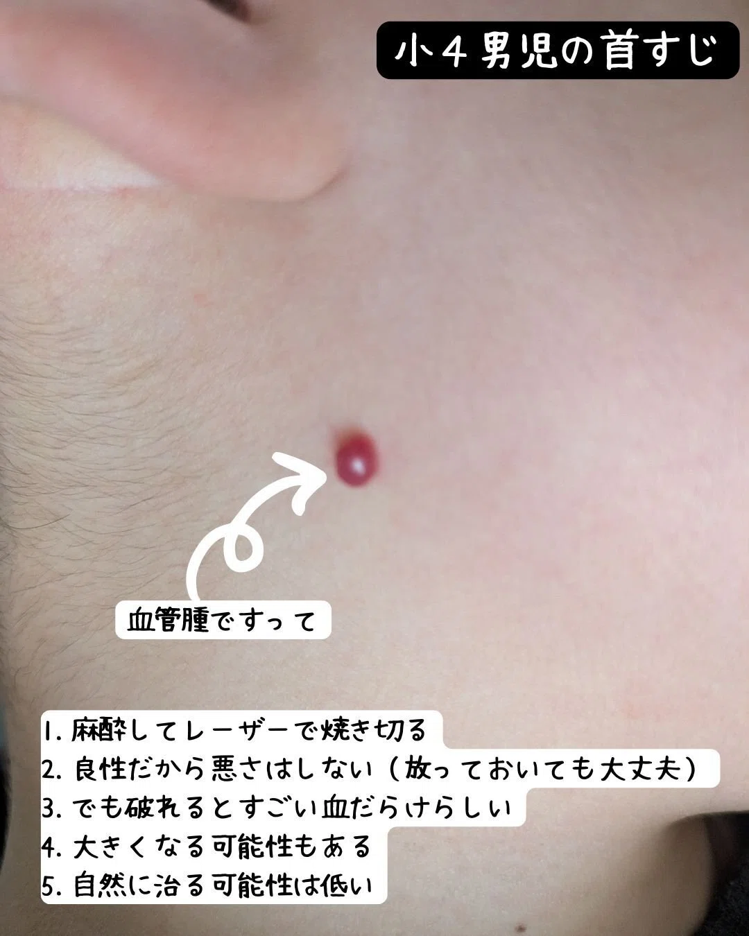 血管腫