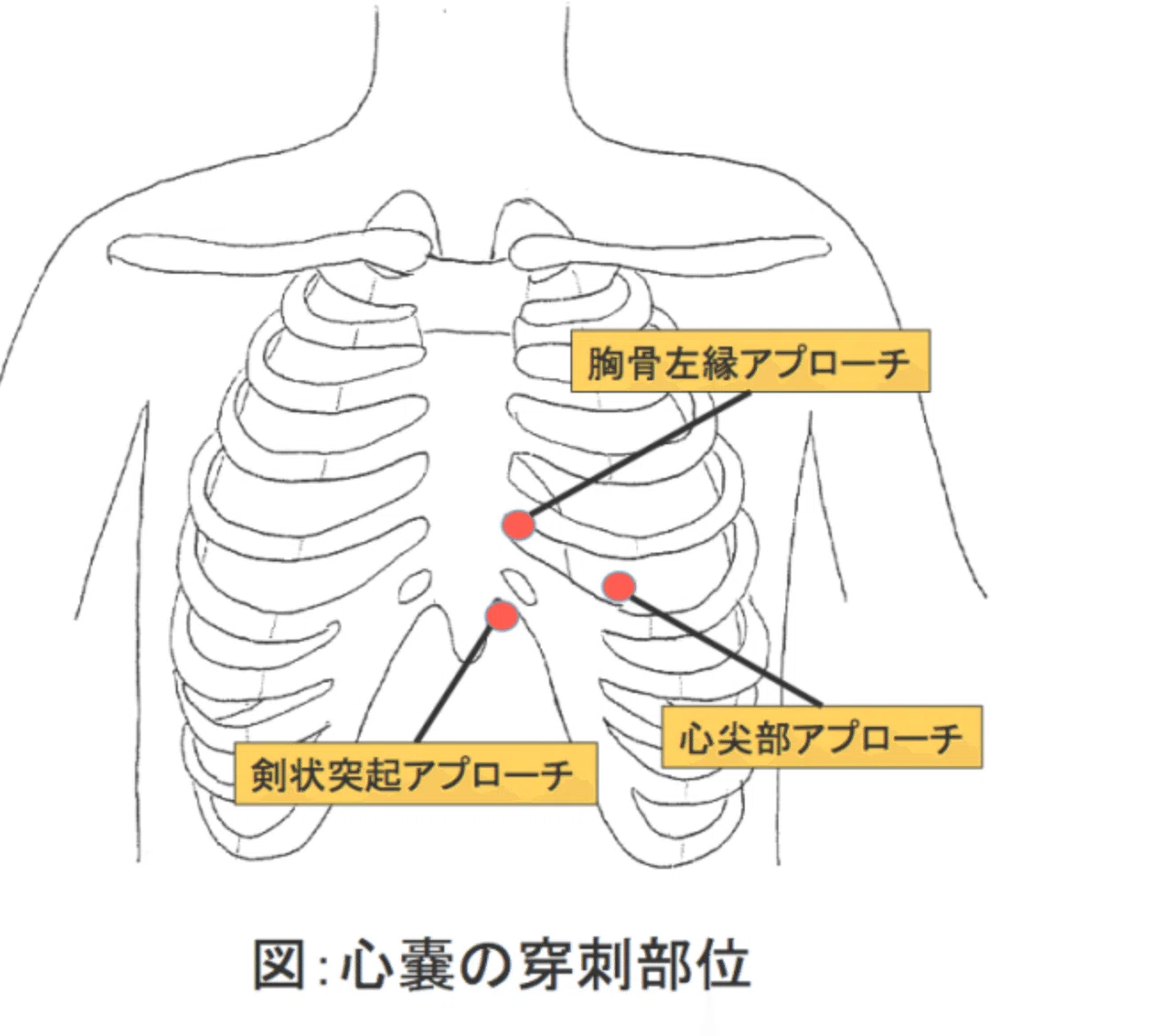 コツを覚えて必ずできる！体腔穿刺 部位・臓器別にみる間違いの