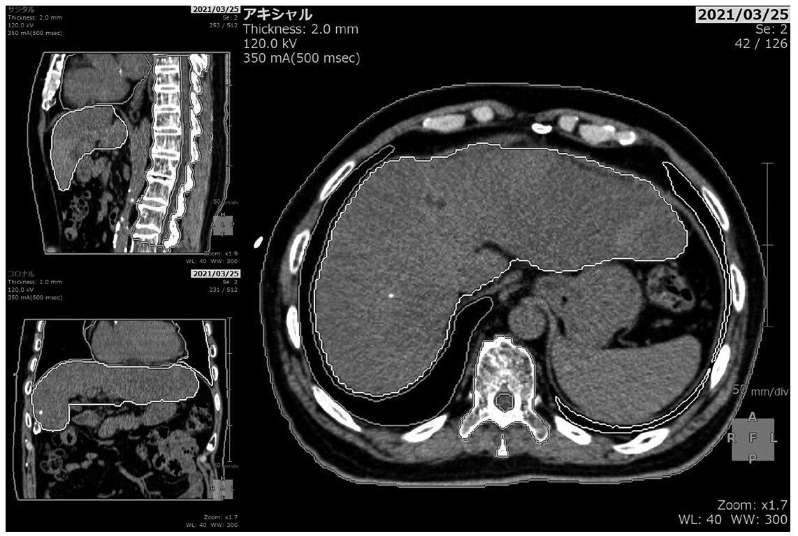 放射線治療計画支援装置「SYNAPSE Radiotherapy」がもたらす治療計画の