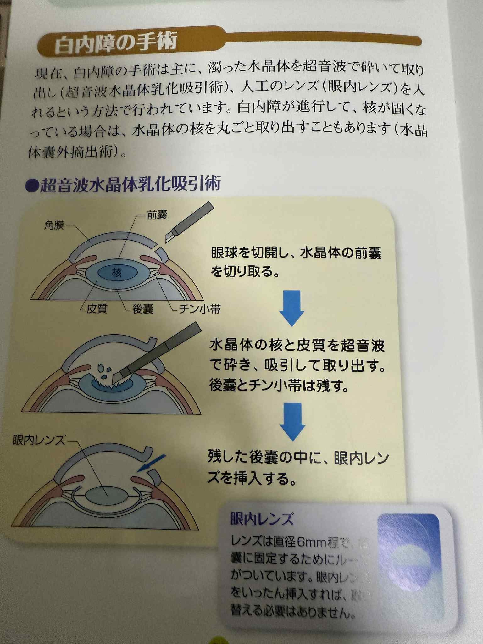 43歳で白内障になった話｜せんがちゃん