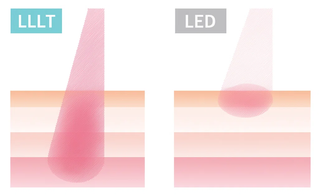 LLLTとLEDの違い