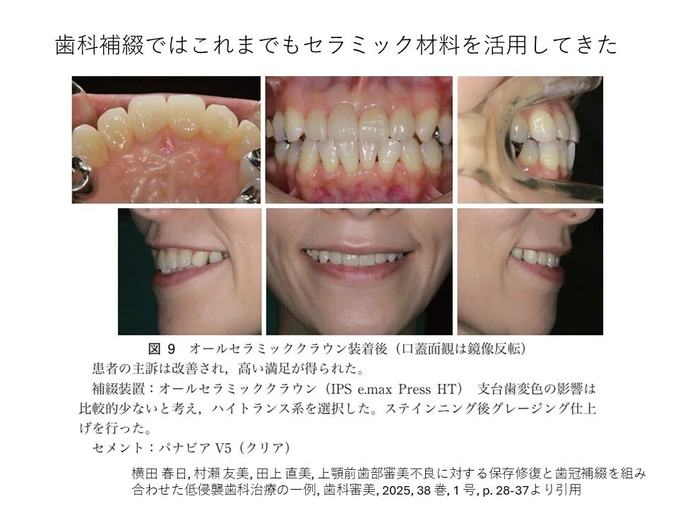 ジルコニアが一撃で分かるお話｜まもる