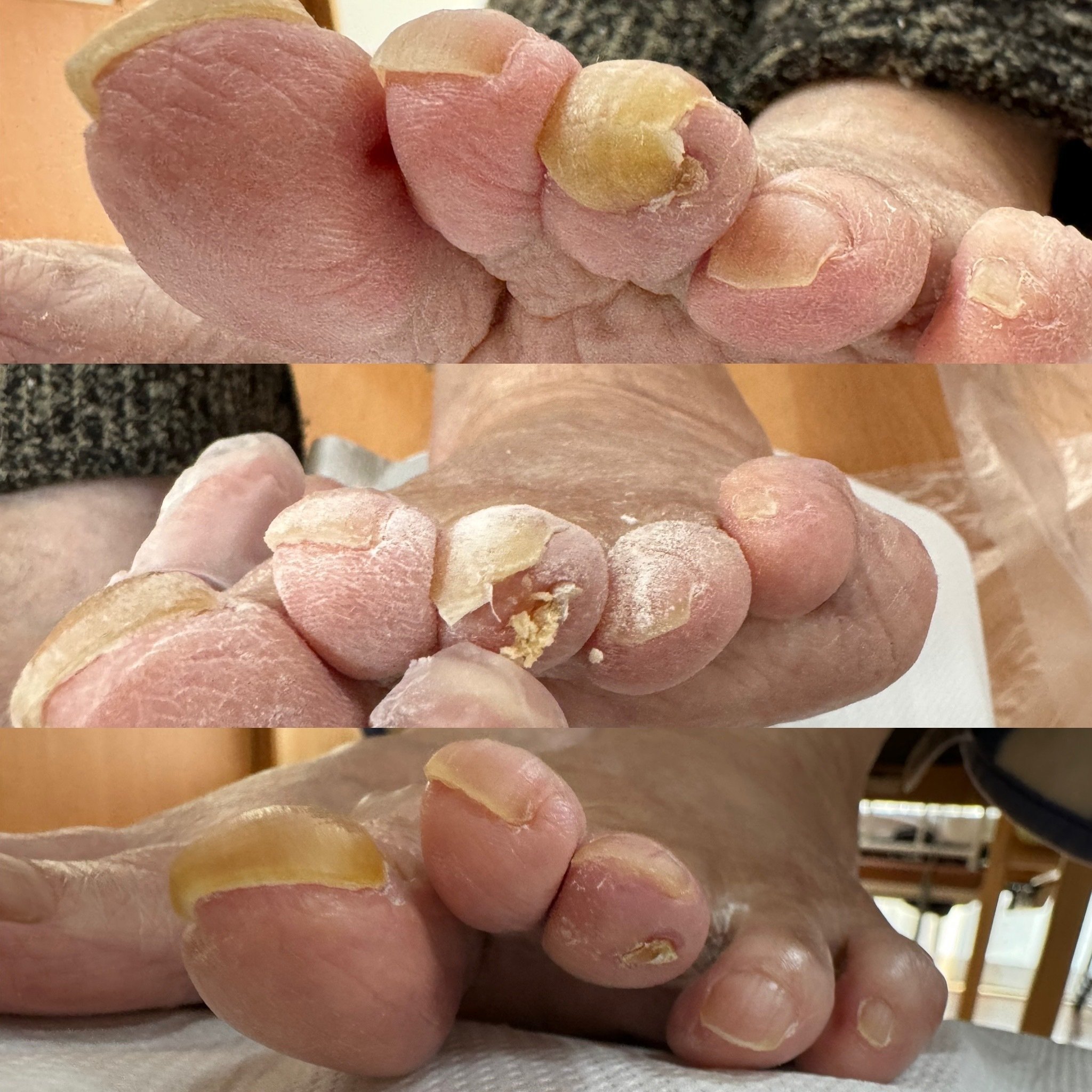 足の爪が伸びていることが要因で介護が必要になる方も｜フットスター