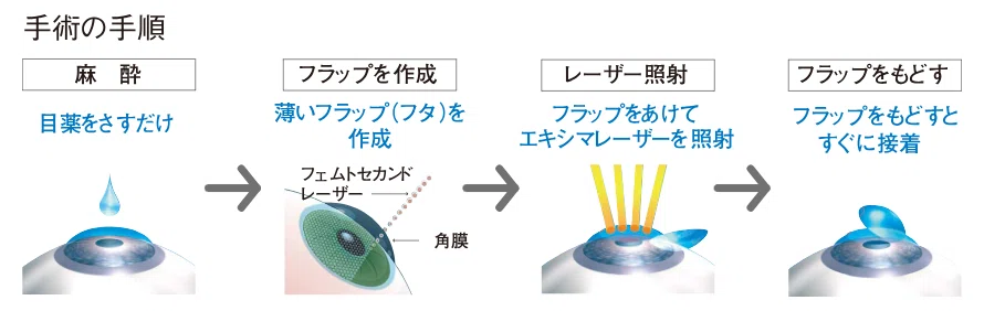レーシック手術の流れ