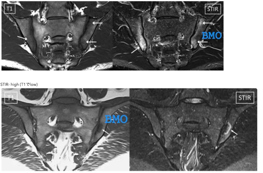 7 Axial Spondyloarthritis - 軸性脊椎関節炎/いわゆる強直性脊椎炎