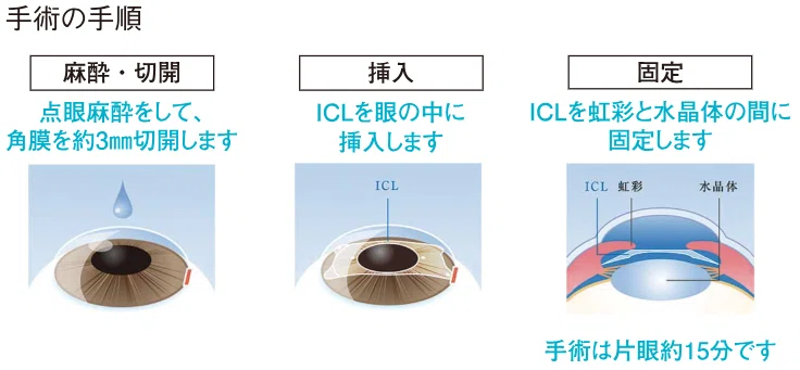 ICL手術の手順