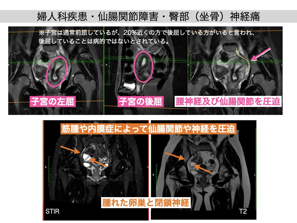 婦人科と仙腸関節障害｜西村 公典