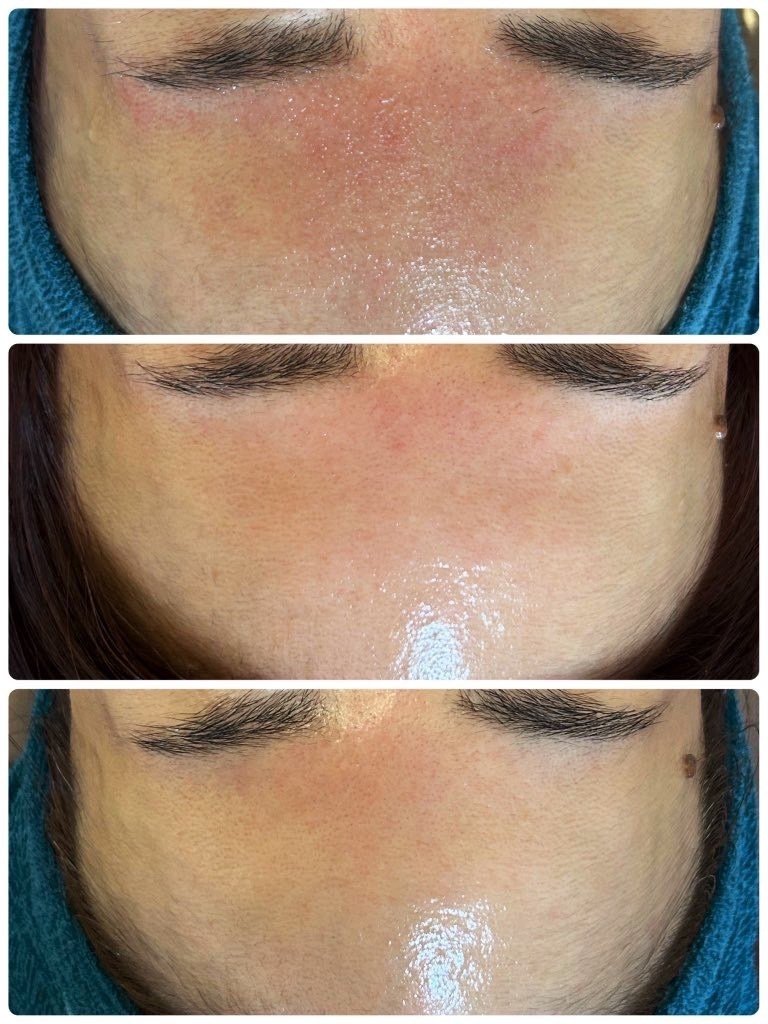 お得な3回分です★最新☆ピーリング！ララピールより効果的！進化版のプラピール✨⭐️ LHALALA PEEL(ララピール)｜公式代理店｜株式会社シンビシン