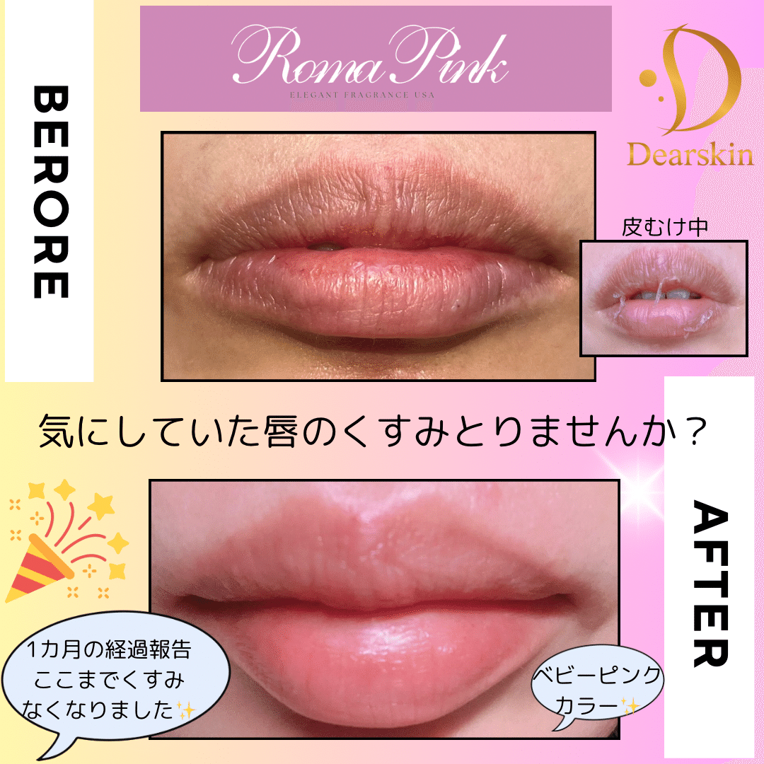 ローマピンクRomaPinkアフタークリーム20本 正規品 Roma Pink ホワイト アフタークリーム ローマピンク（Roma Pink