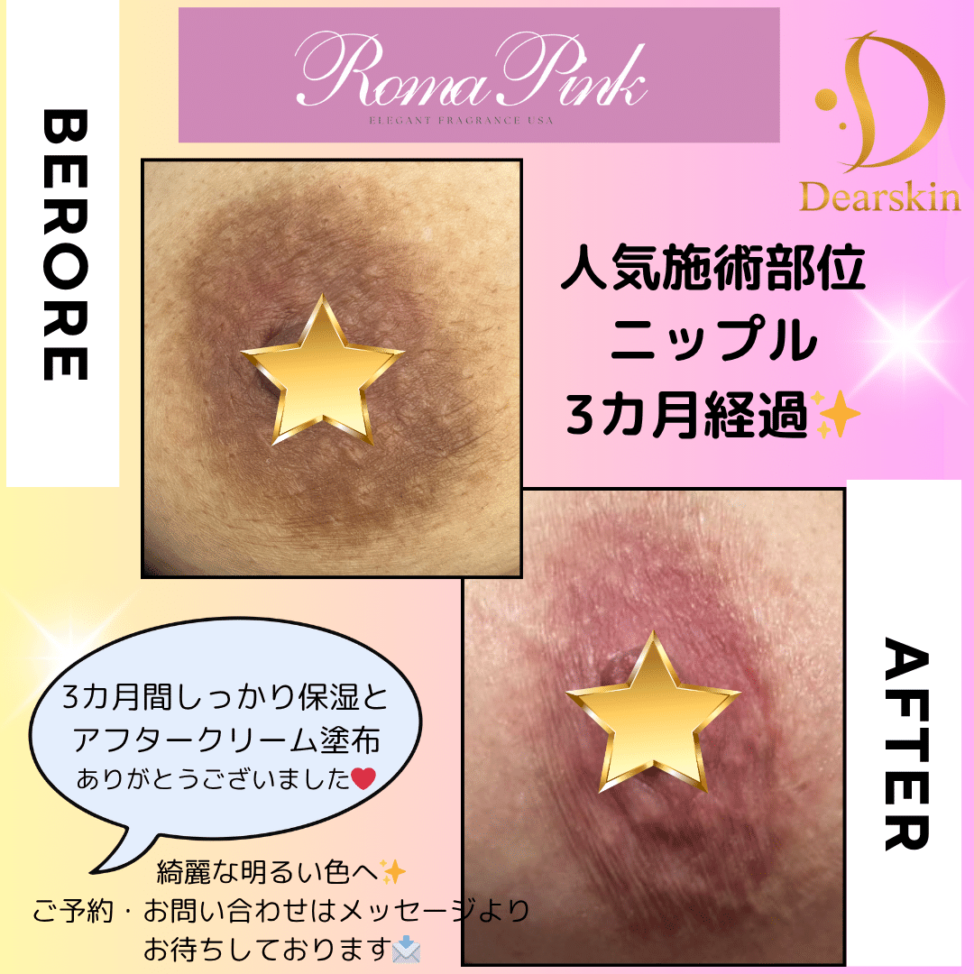 長野で今話題のローマピンクを施術するなら、どこのサロンがおすすめ