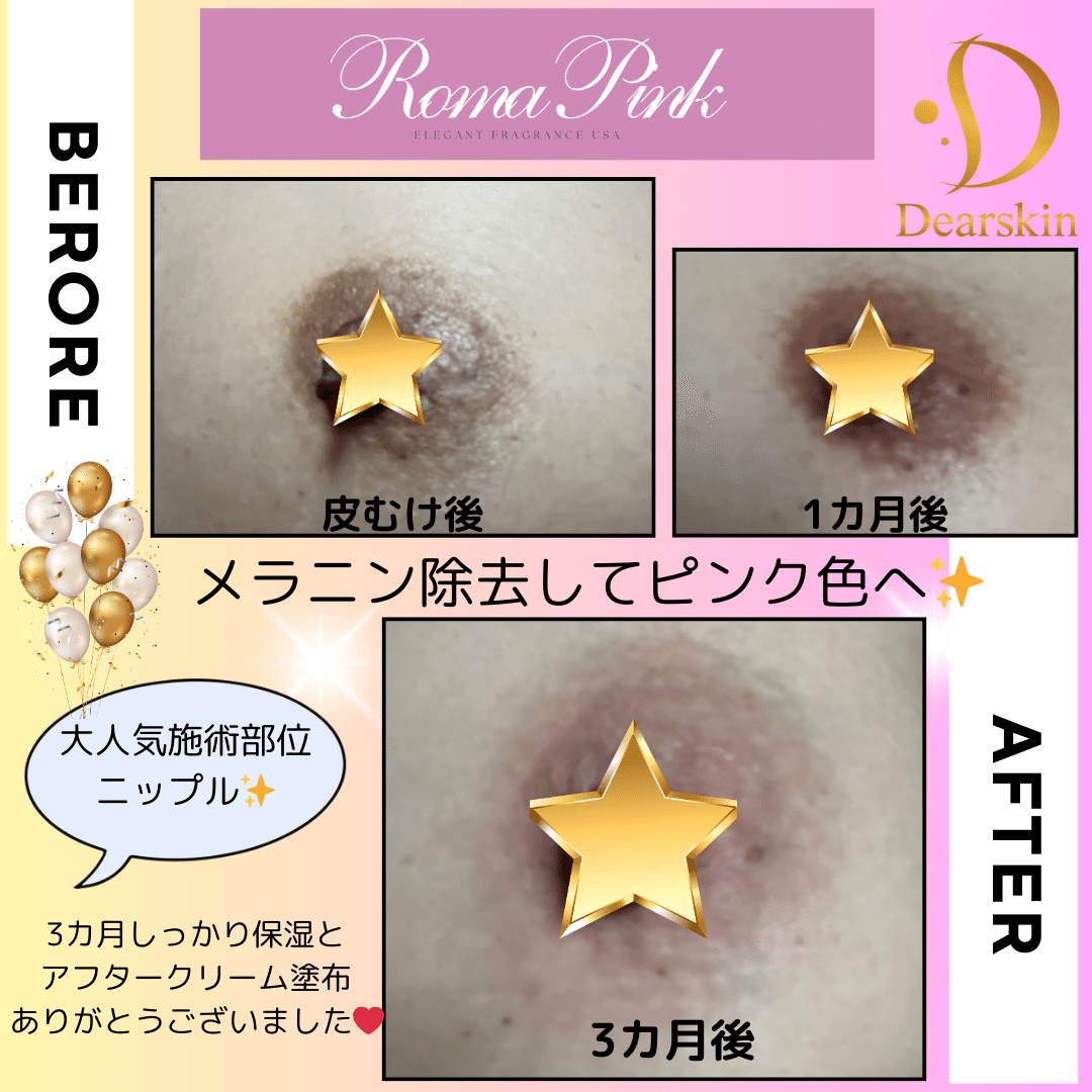 長野で今話題のローマピンクを施術するなら、どこのサロンがおすすめ