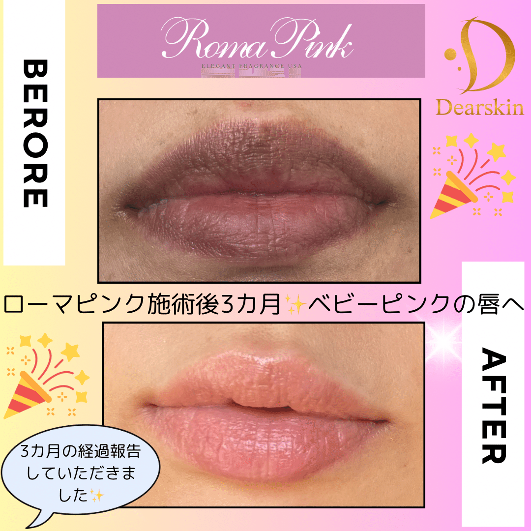 長野で今話題のローマピンクを施術するなら、どこのサロンがおすすめ