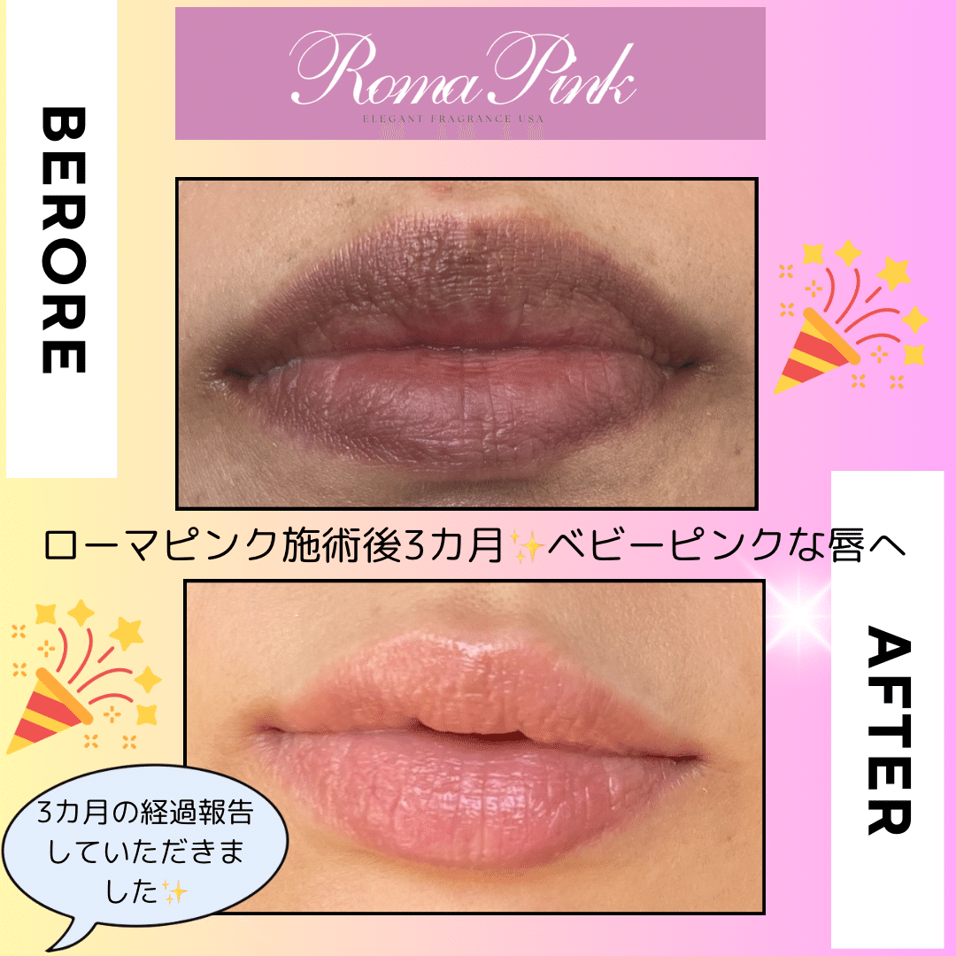 話題のローマピンク、施術方法は？ダウンタイムは？ （Dearskin