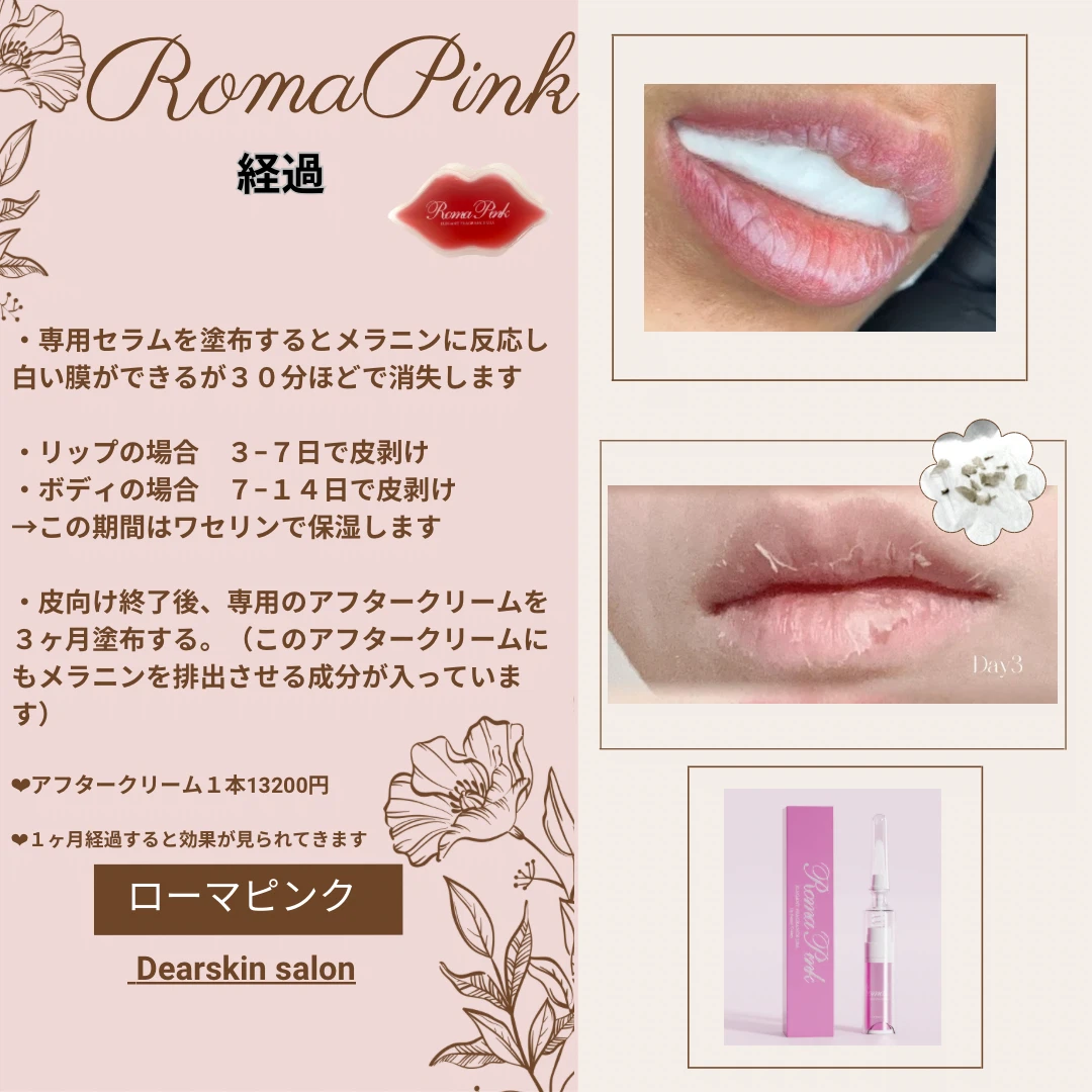話題のローマピンク、施術方法は?ダウンタイムは? (Dearskin 話題のローマピンク、施術方法は?ダウンタイムは? (Dearskin