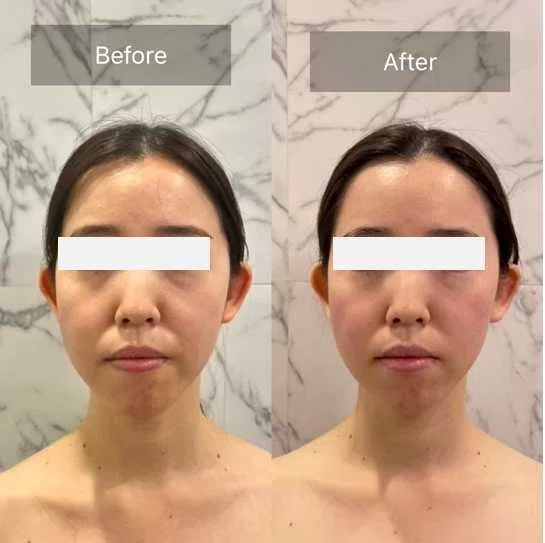 5分で実感。バストもフェイスラインも“上向く”】──HIFUでもEMSでも