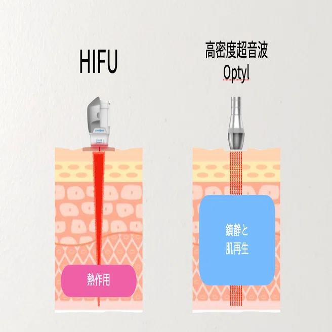 高密度超音波とは？従来のHIFUとの違いと「炎症レス美容」の時代へ｜近