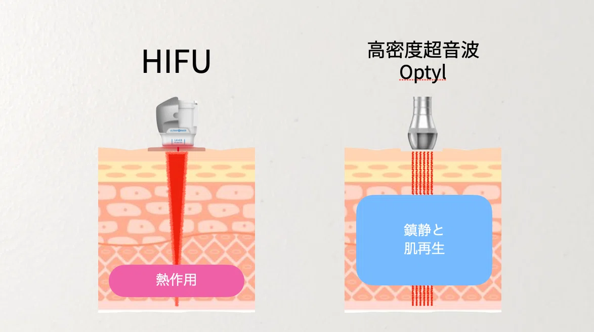 高密度超音波とは？従来のHIFUとの違いと「炎症レス美容」の時代へ｜近