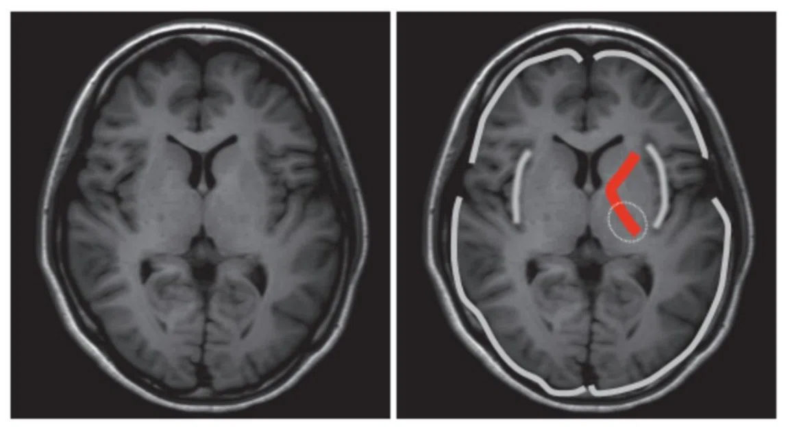脳卒中画像から読み解く症状とリハビリ CT・MRI・FLAIR画像から損傷部位と症状の関係をやさしく解説｜taka@理学療法士