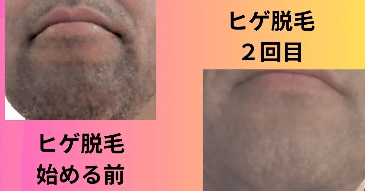 40年の結論】青ひげ解決🎉自宅でできる唯一の最終手段「トリア」徹底