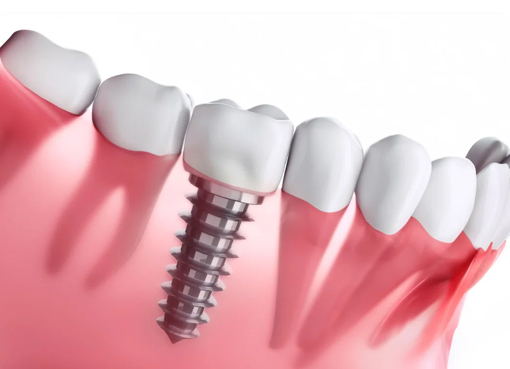 Sinus Scan Reliable Implant Treatment through “Transparent Pricing × Long-term ...