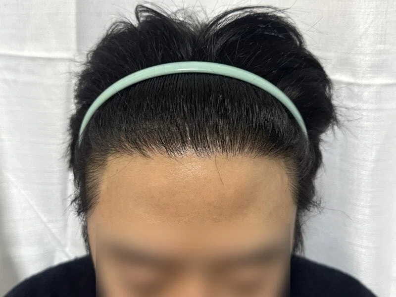 DA 美容外科 非切開植毛