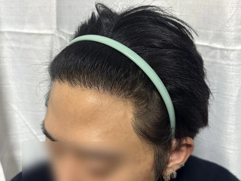 DA 美容外科 非切開植毛
