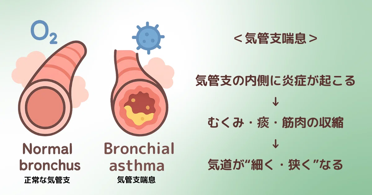 気管支喘息のしくみを“つながる理解”で整理しよう｜看護学生の勉強部屋