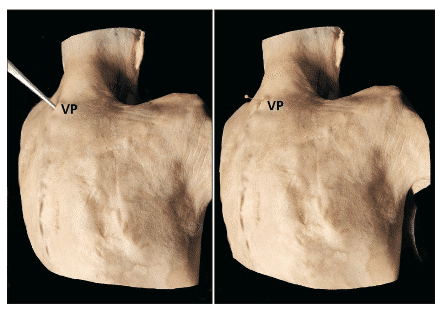 骨触診による脊椎レベルの同定｜理学療法士による臨床のためのnote
