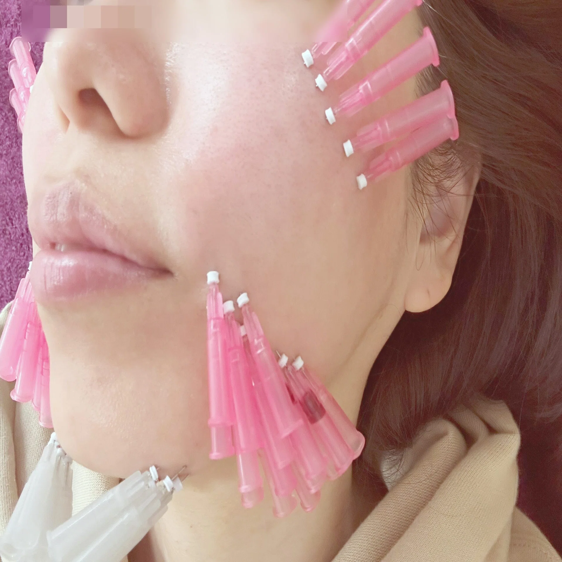 韓国美容】50本約2万円のショッピングリフト受けてきた！｜masaco