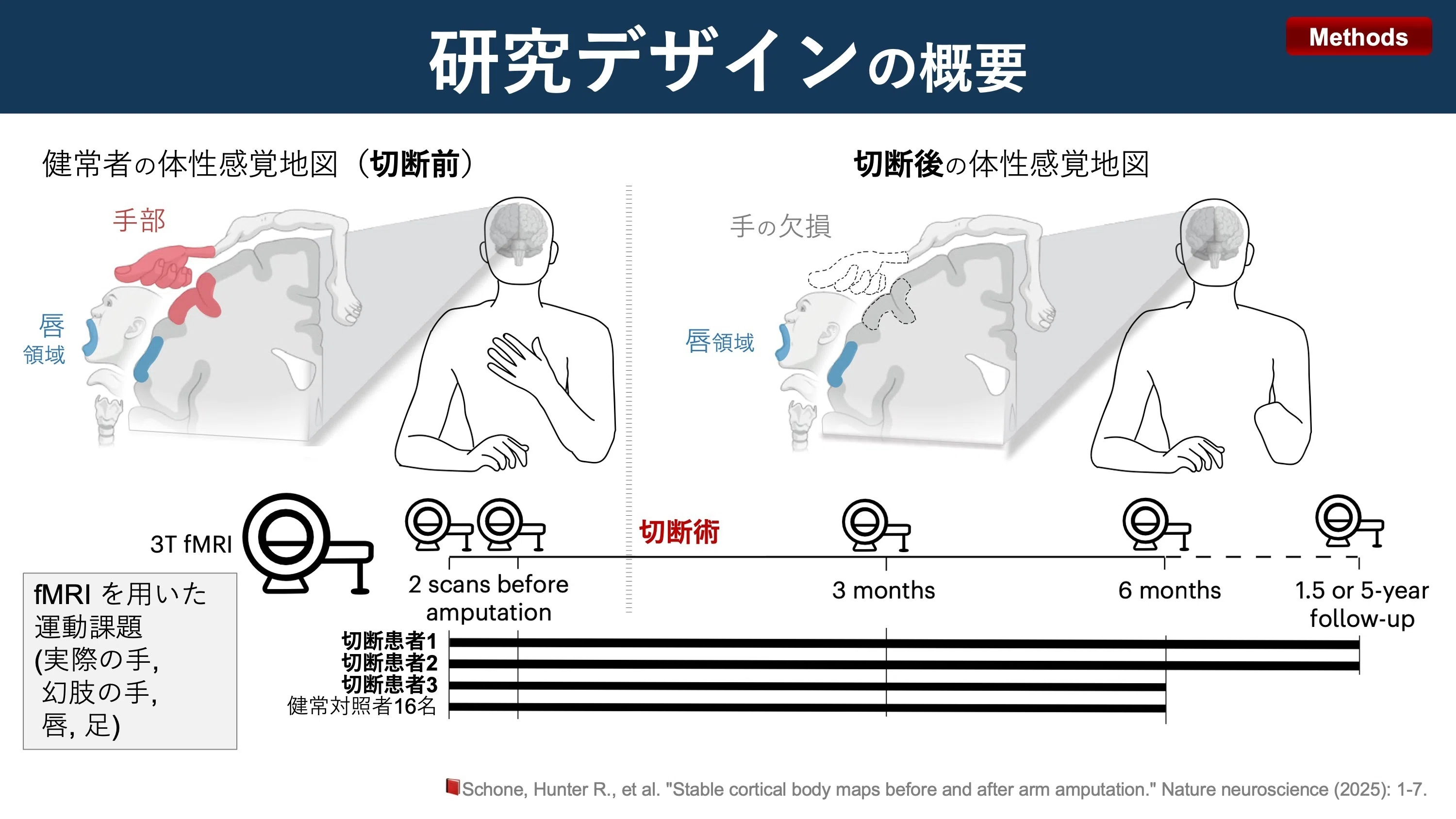 脳の身体地図は失った手を忘れない｜Super Human | 理学療法士／保健学