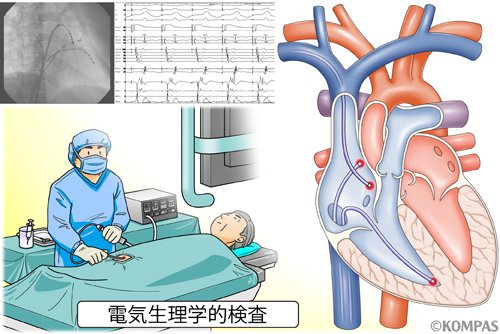EPS(心臓電気生理学的検査)を受けてみて｜にゅ