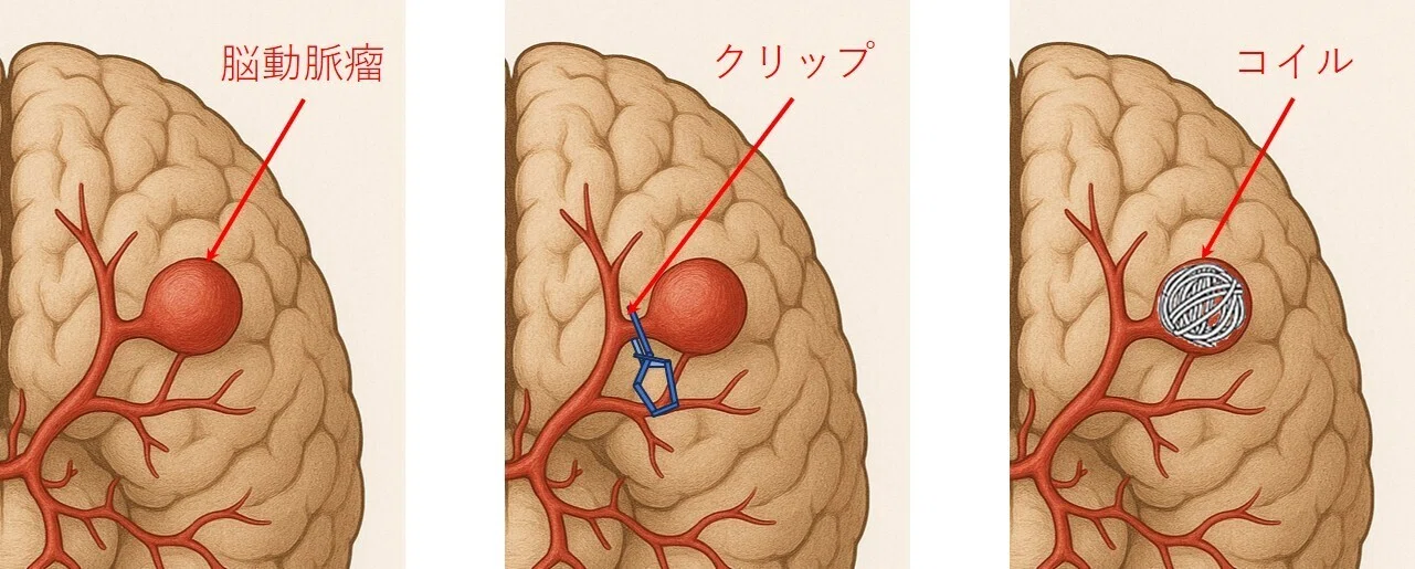 脳動脈瘤の治療｜英司